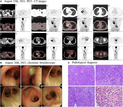 Case report: an initially unresectable stage III pulmonary sarcomatoid carcinoma qith EGFR mutation achieving pathological complete response following neoadjuvant therapy with osimertinib plus chemotherapy